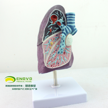 ENOVO正品医用人体肺模型 吸烟者  胸外科呼吸科模型